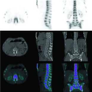 bone scan